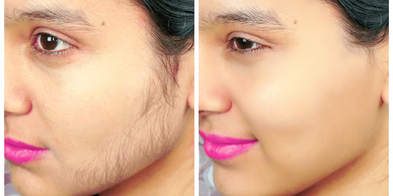 Aşırı Tüylenme Aşırı Tüylenme