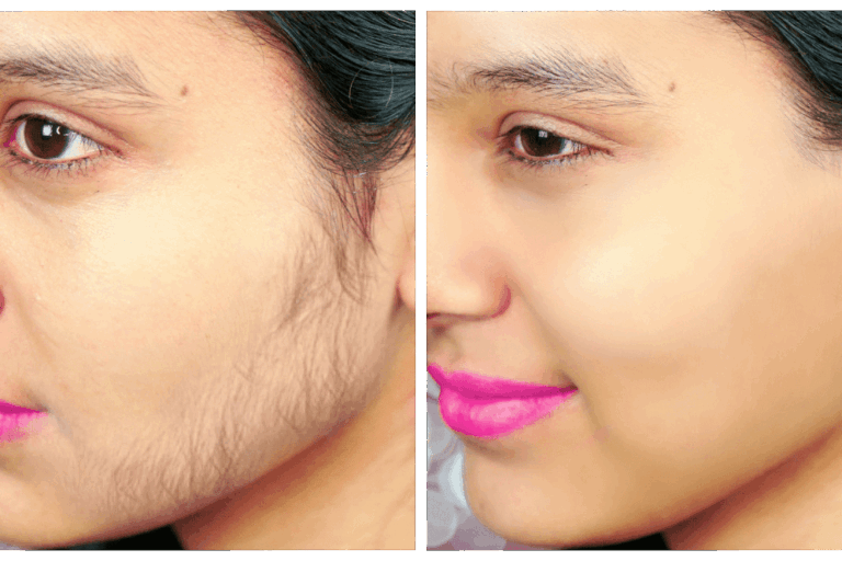 Aşırı Tüylenme Aşırı Tüylenme