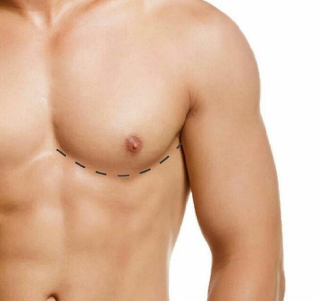 Erkekte Meme Büyümesi Erkekte Meme Büyümesi