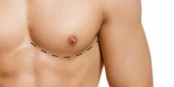 Erkekte Meme Büyümesi