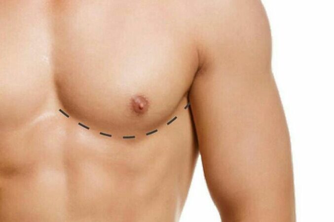 Erkekte Meme Büyümesi Erkekte Meme Büyümesi