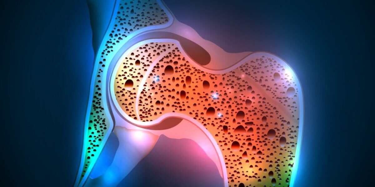 Kemik Erimesi Kemik Erimesi