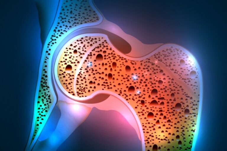 Kemik Erimesi Kemik Erimesi